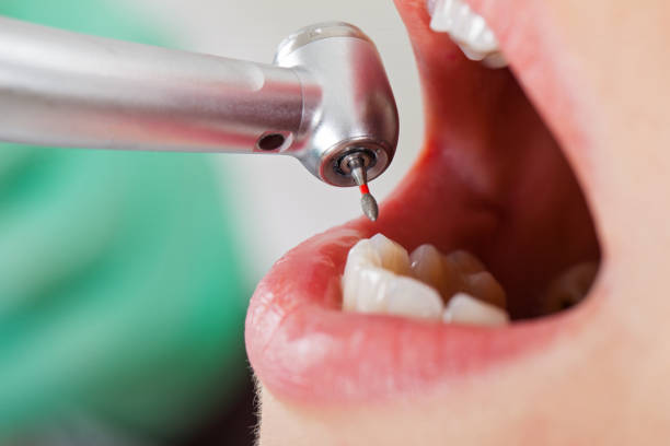 Best Emergency Treatment for Toothache in Forsyth, GA